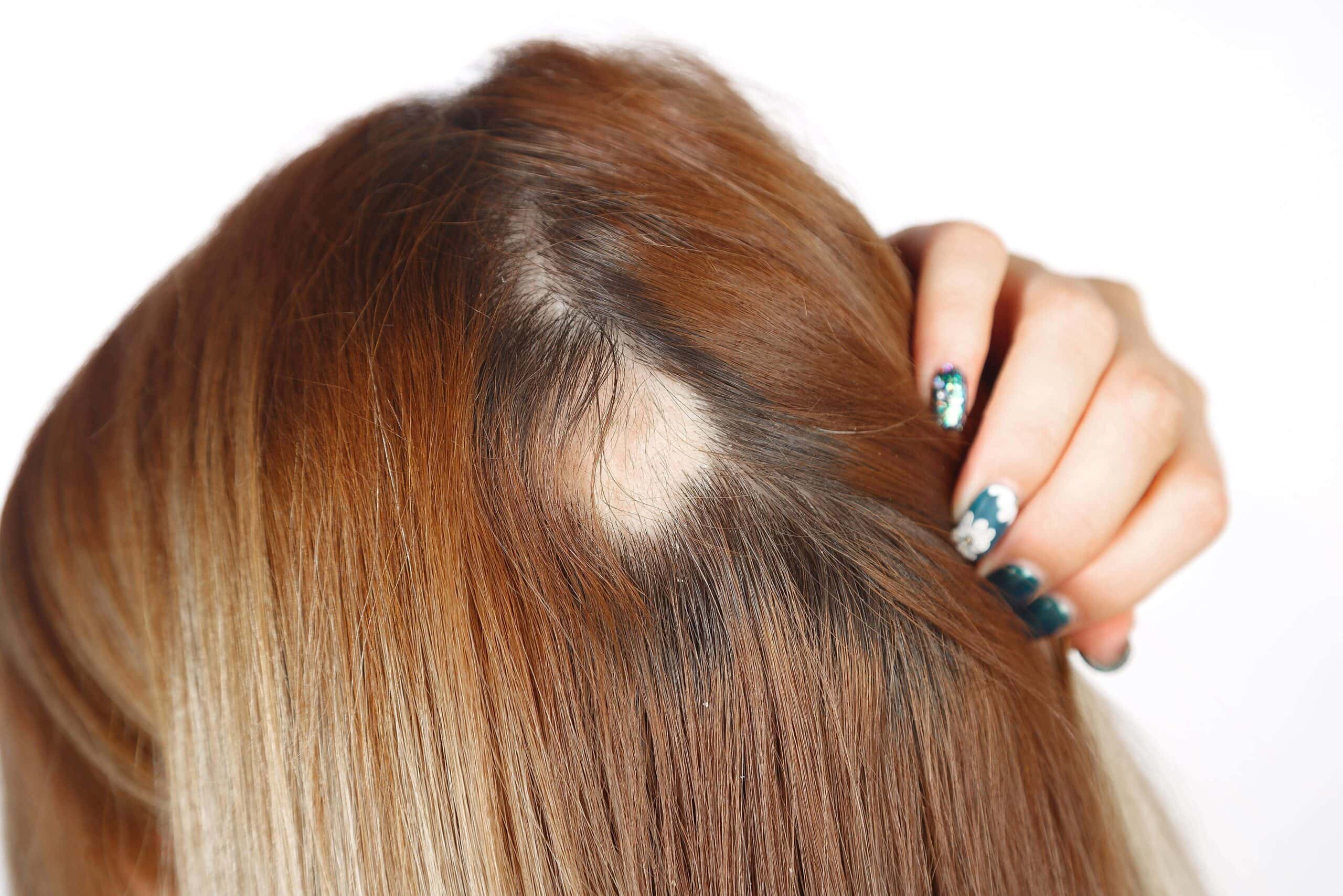 Kopaszság alopecia