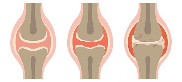 Az osteoarthritis tünetei